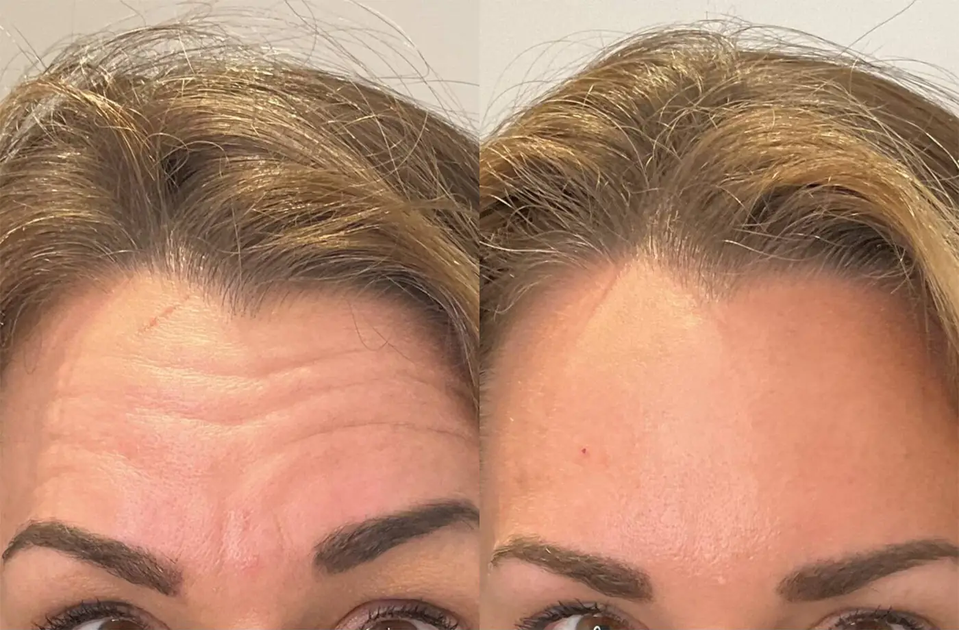Forehead line wrinkle Botox before and after in Rotterdam