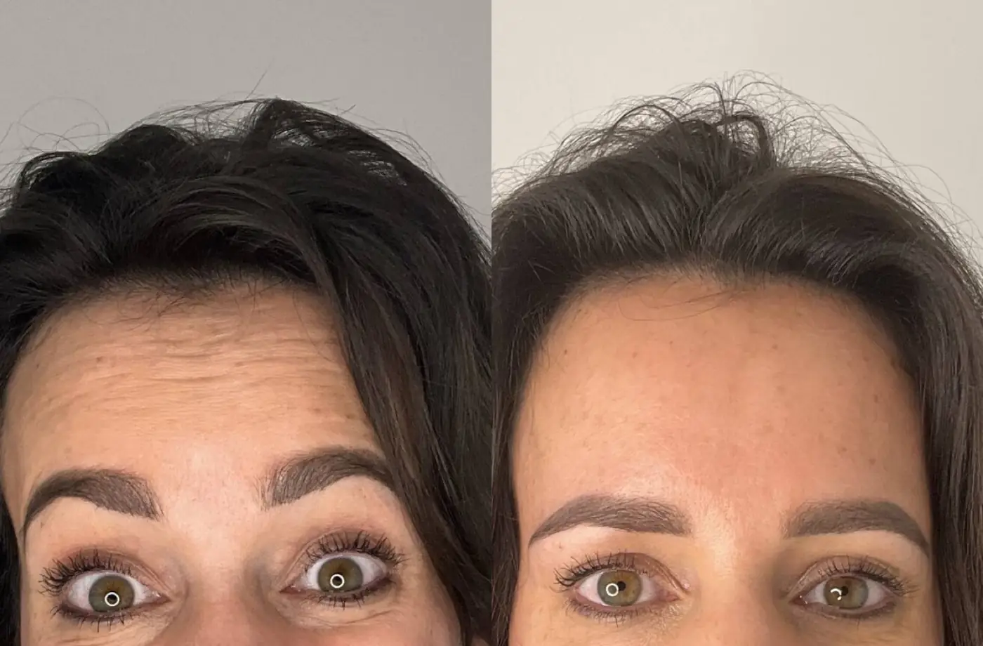 Forehead Botox before and after at Aēstec Rotterdam