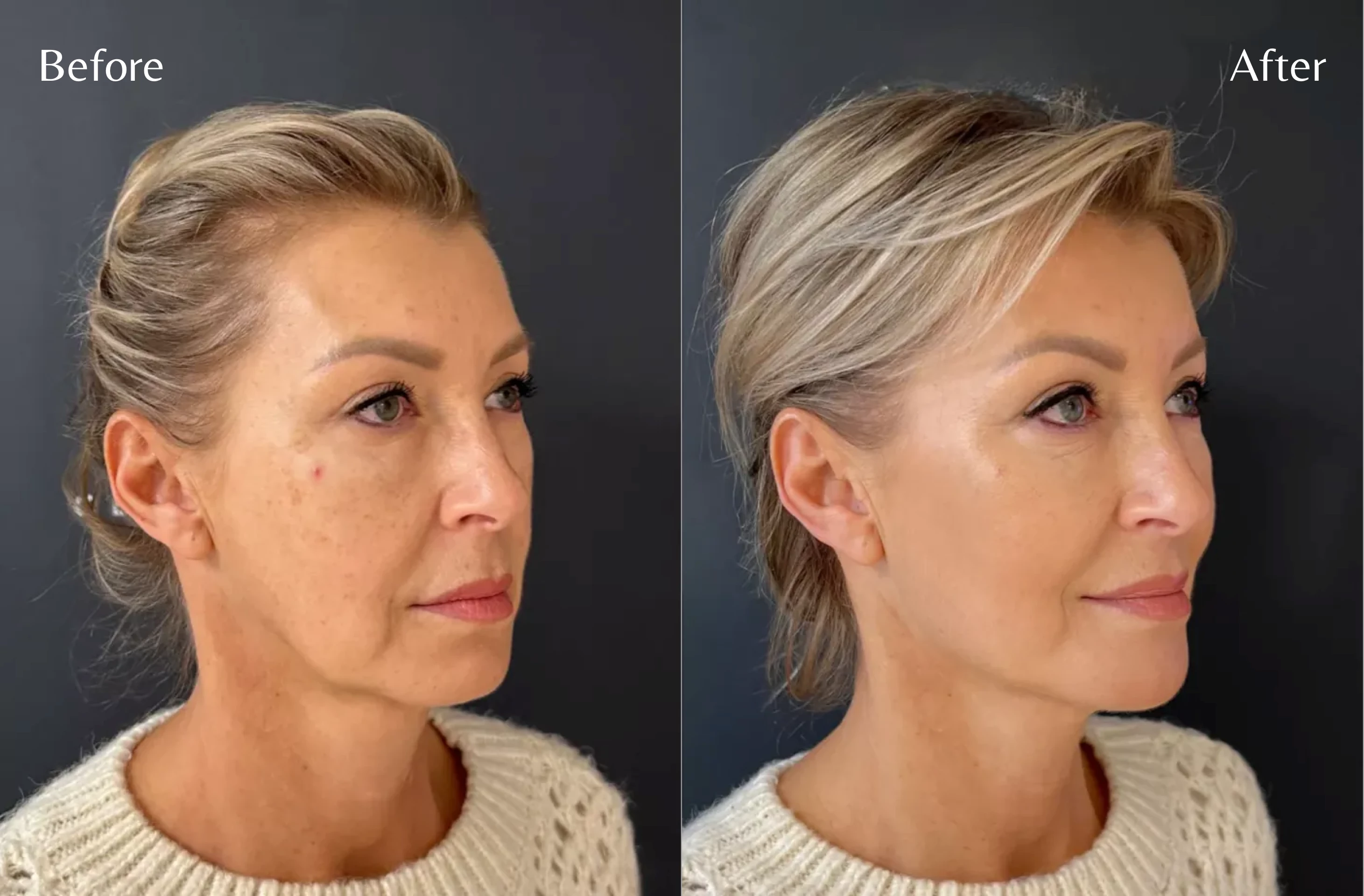 Aēslift Liquid Facelift 