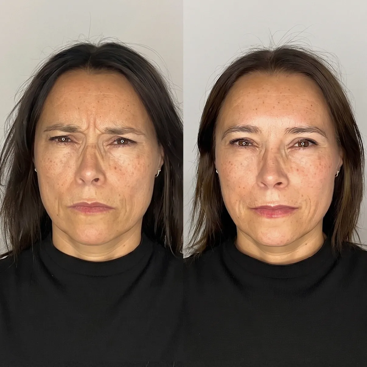 Jukbeenderen botox voor en na