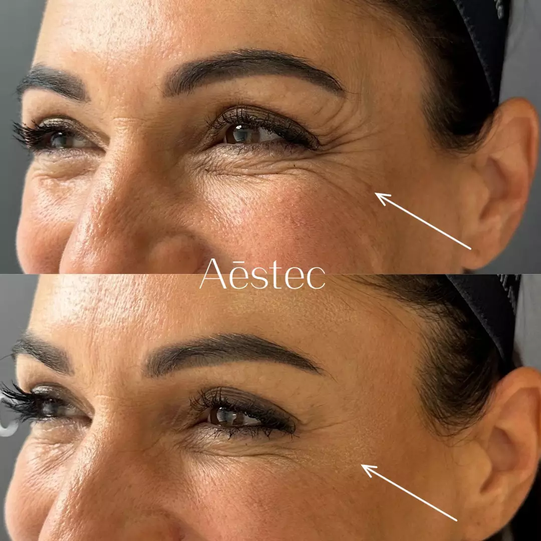 Baby botox behandeling tegen kraaienpootjes rimpels voor en na foto