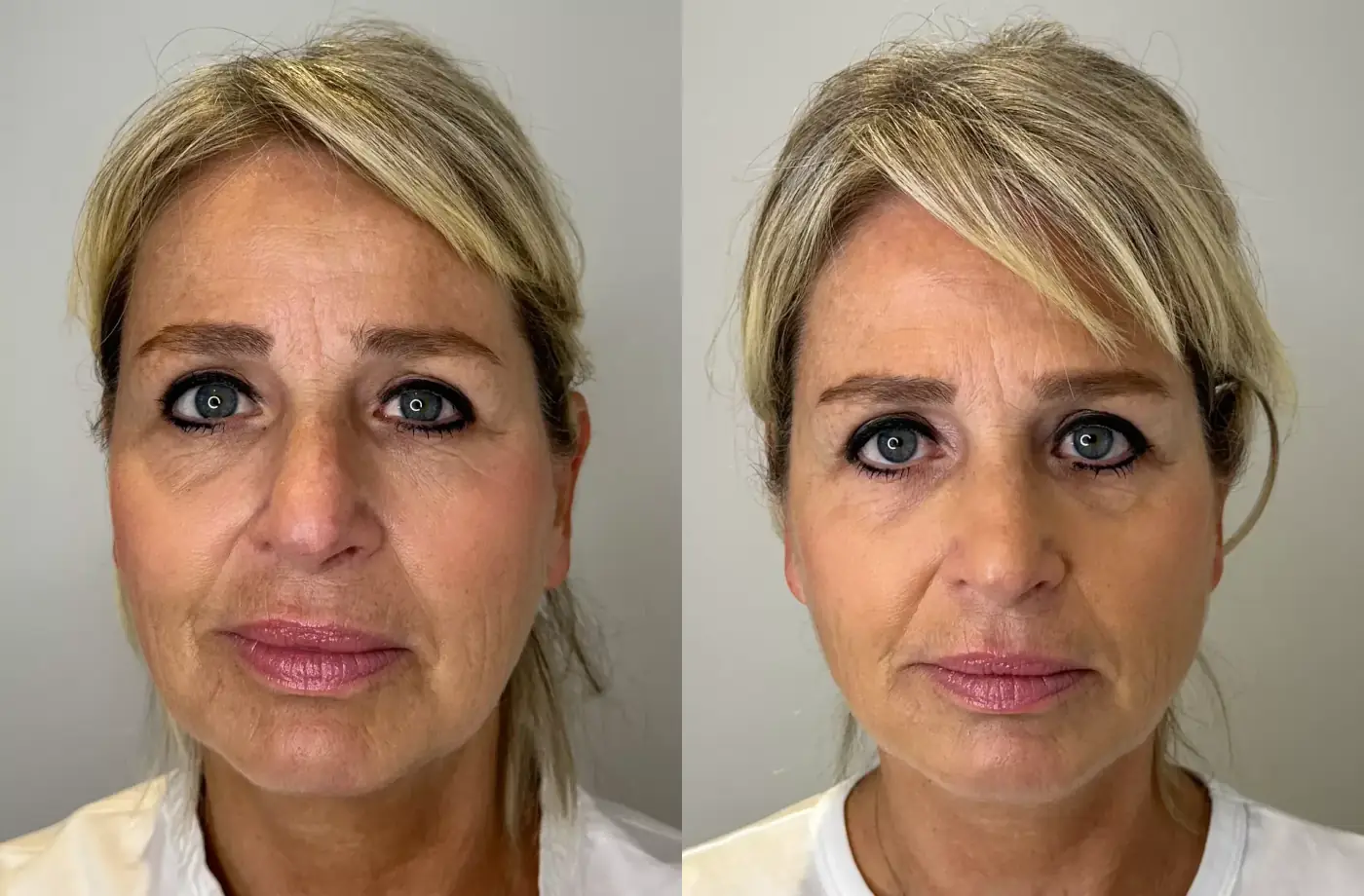 Aēslift fillers voor en na vooraanzicht - Madeleine 53 jaar
