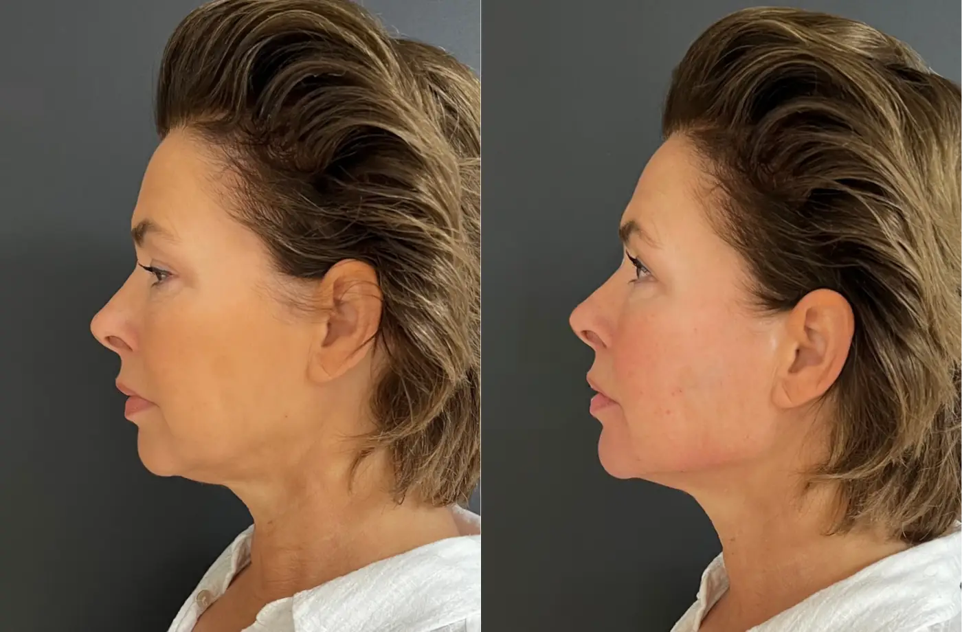 Aēslift filler behandeling voor en na - Natasha 53 jaar
