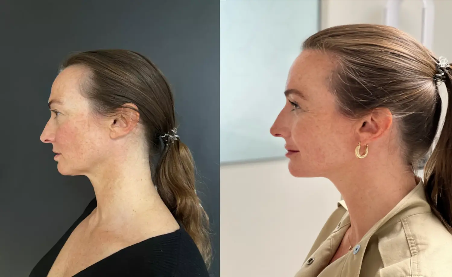 Liquid facelift voor en na foto