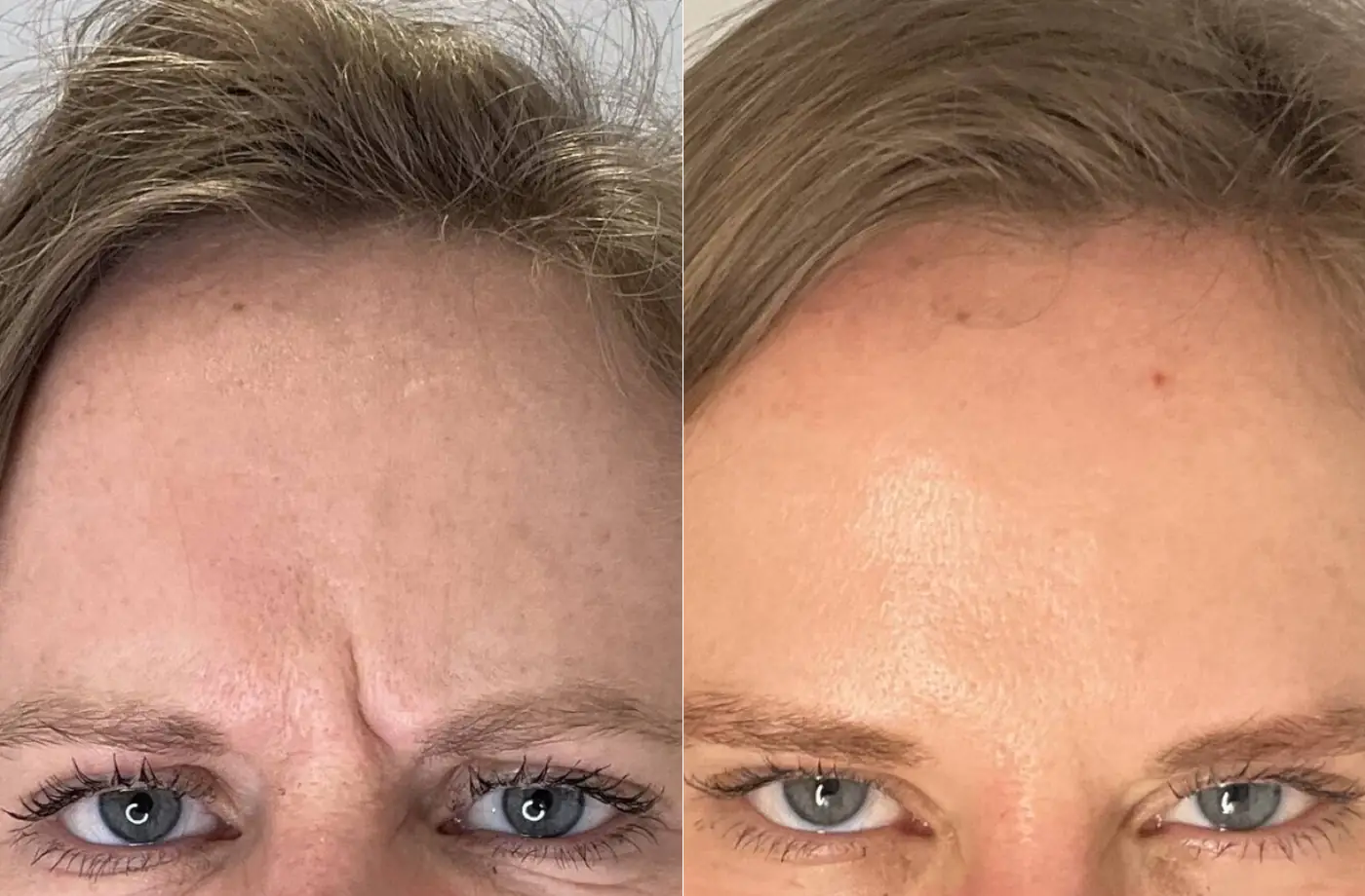 Botox fronsrimpel voor en na