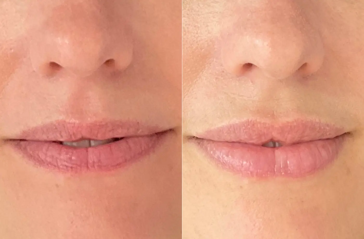 Lip fillers voor en na foto