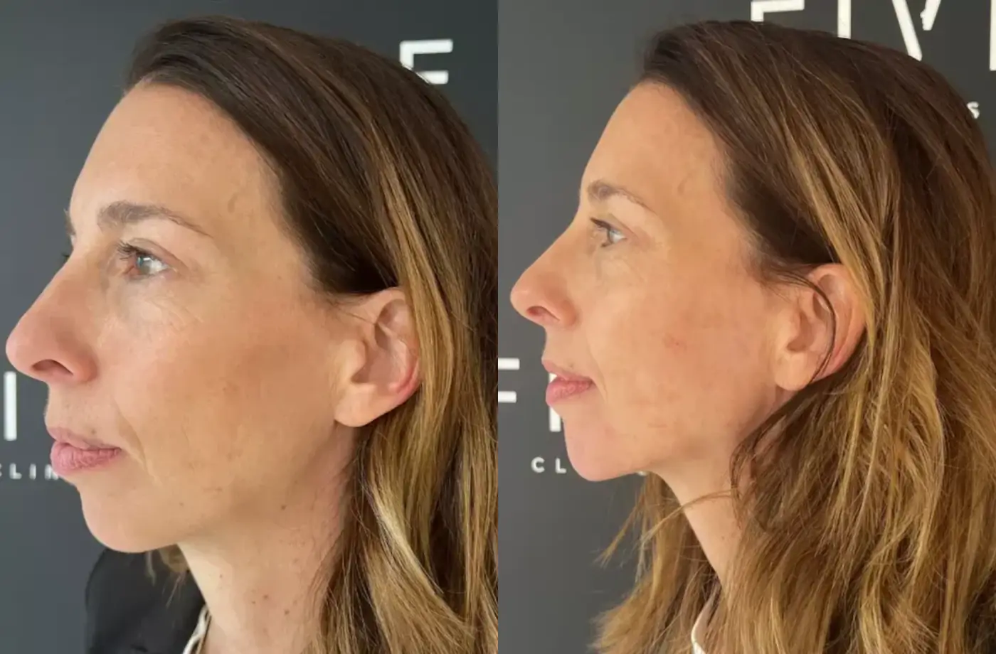 Liquid facelift fotos voor en na