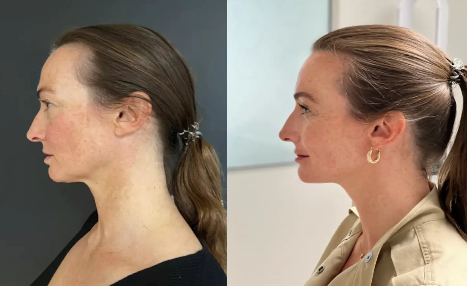 Liquid facelift voor en na foto