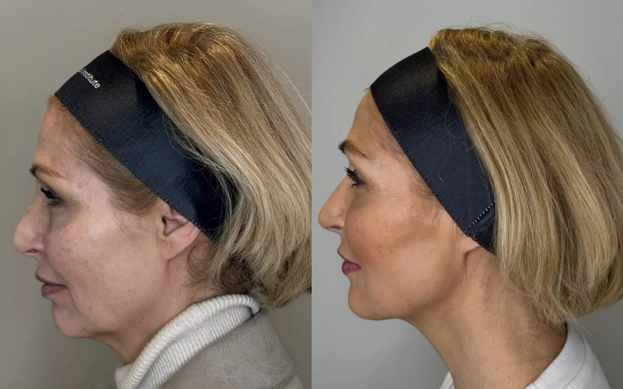 Aeslift ™ behandeling voor en na