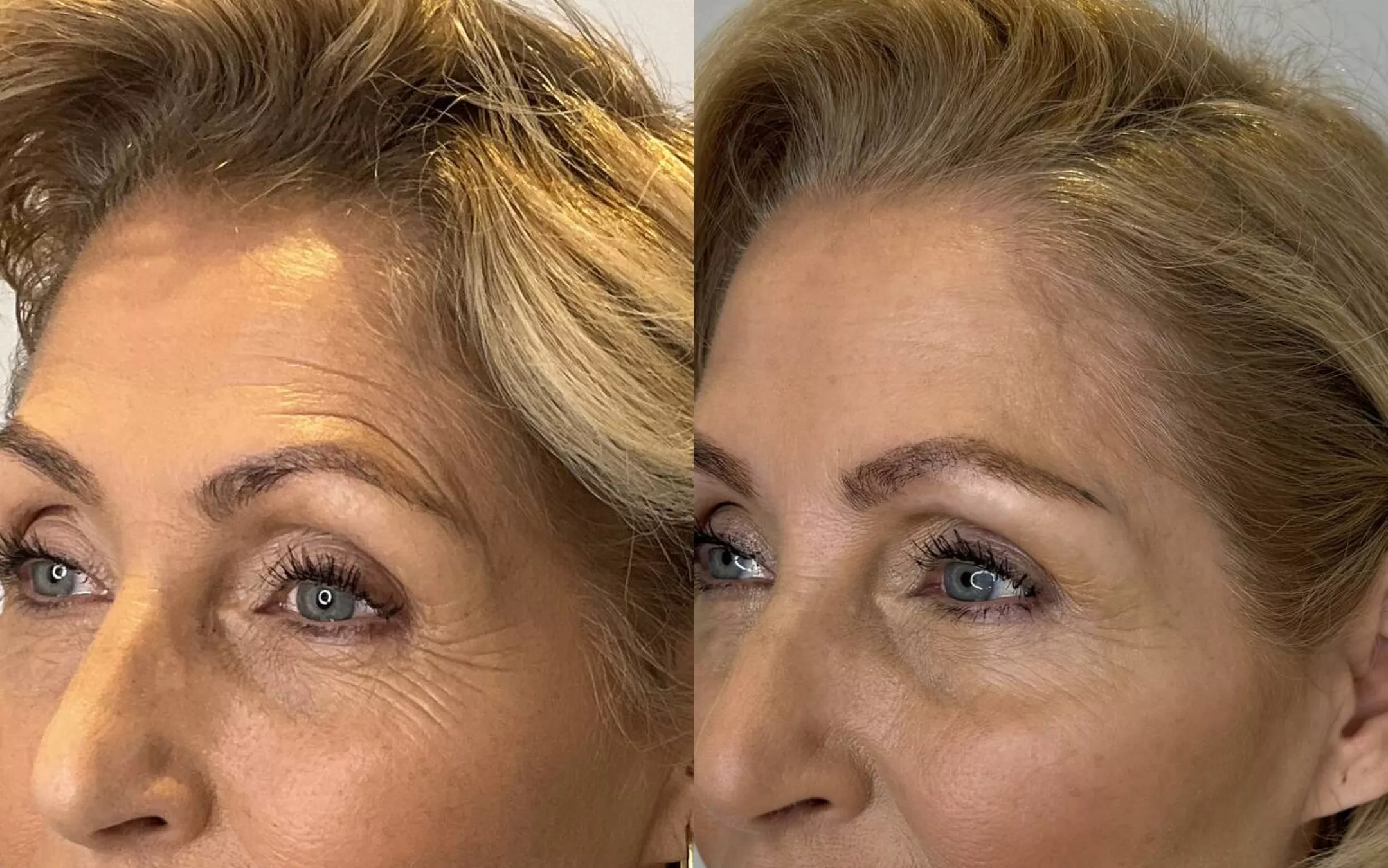 Botox kraaienpootjes