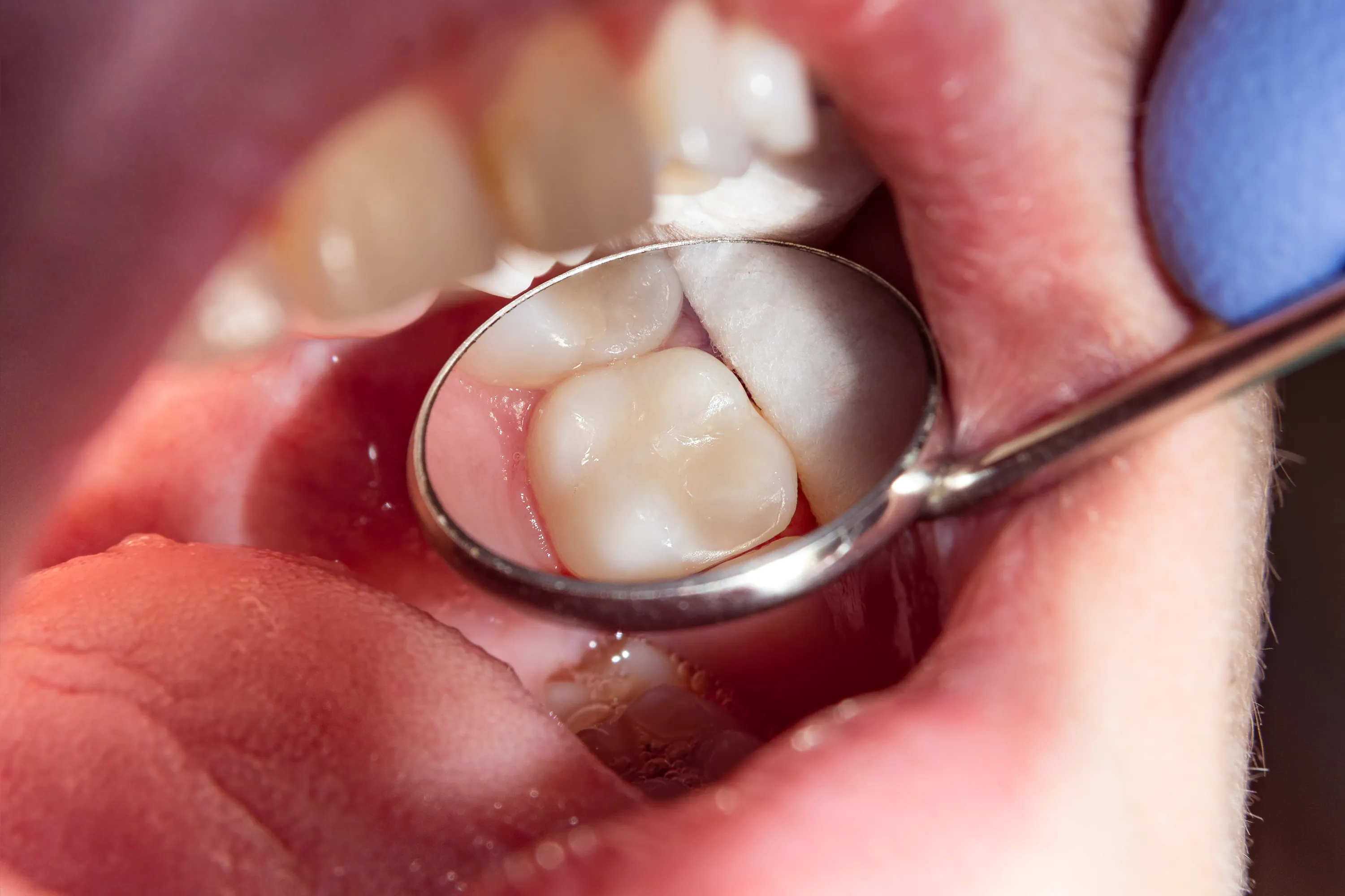 teeth braces