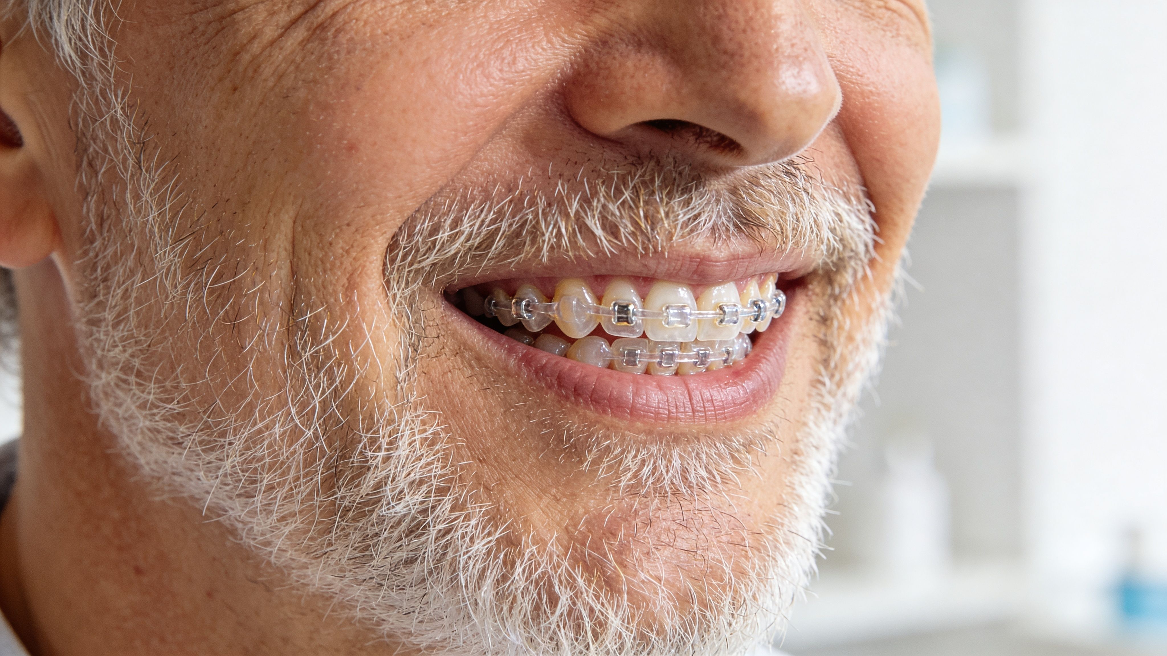 A close-up shot of an older man smiling to show his teeth with clear ceramic braces.