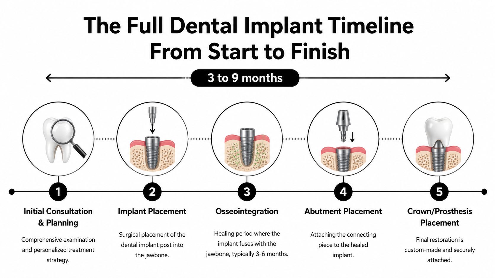 A diagram illustrating the five-step timeline for dental implant surgery from initial consultation to final restoration.