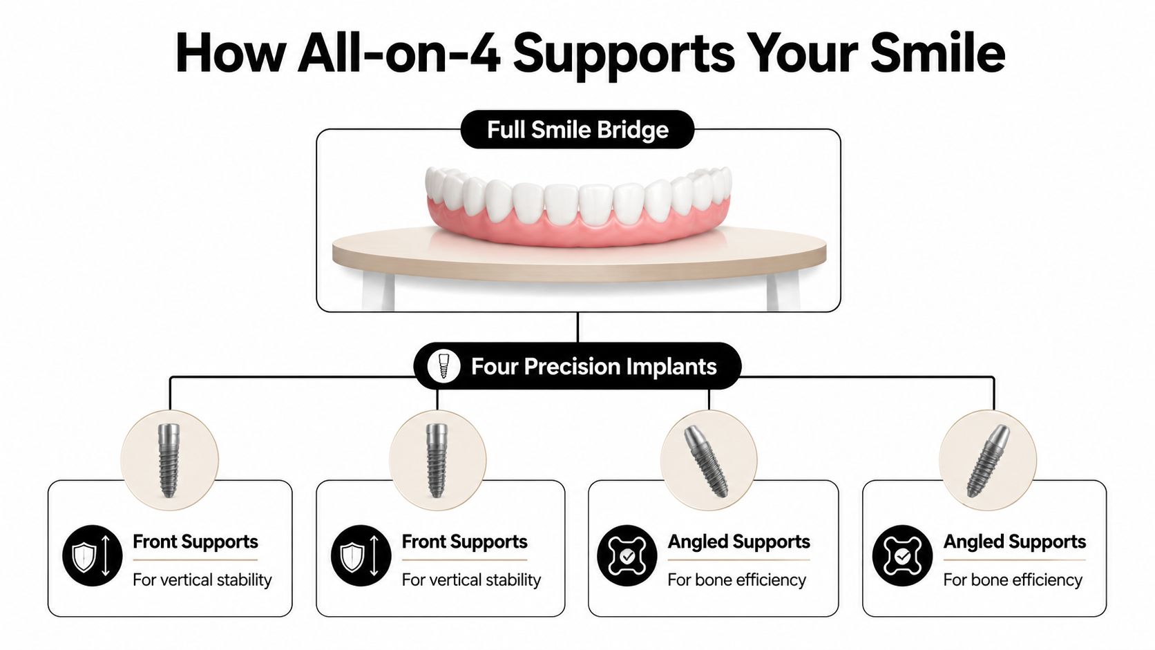 A diagram illustrating how All-on-4 dental implants support a full set of teeth with four implants.