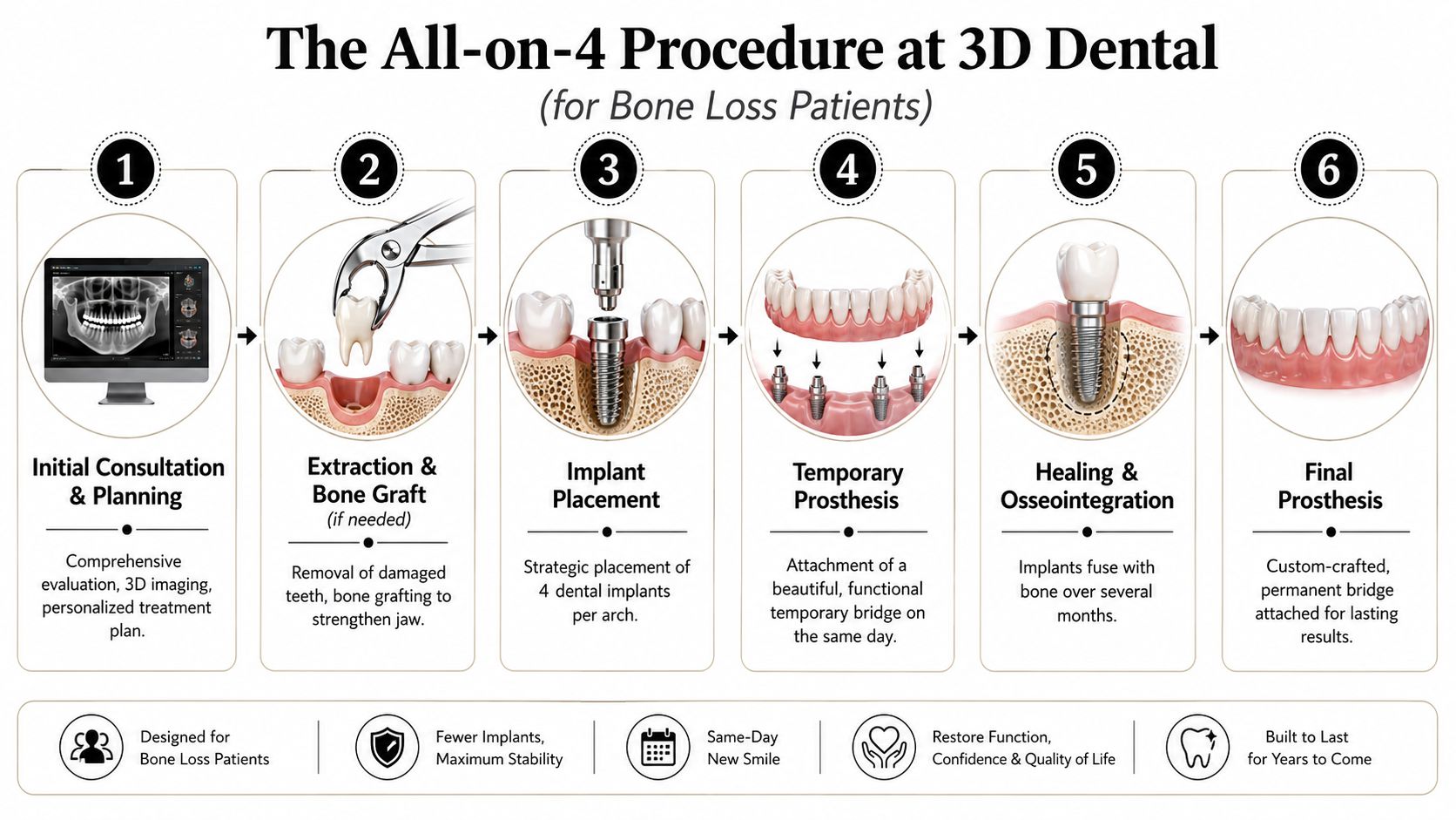 A six-step infographic illustrating the All-on-4 dental implant procedure for patients experiencing bone loss.