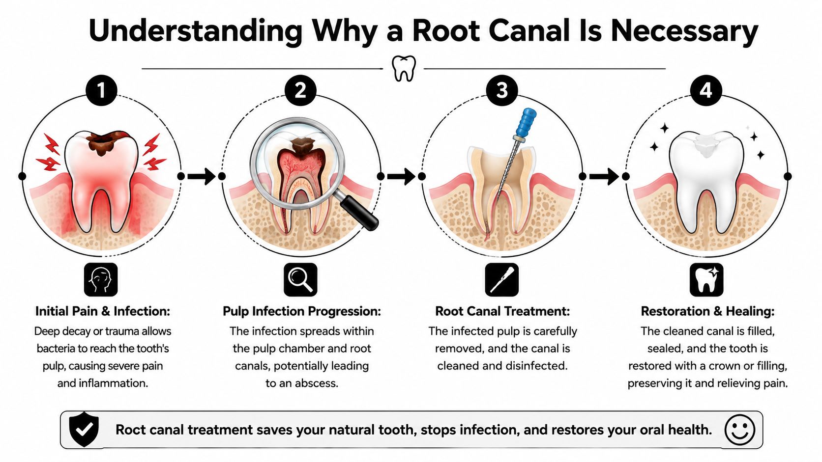 An infographic showing the four stages of a root canal treatment process from infection to restoration.