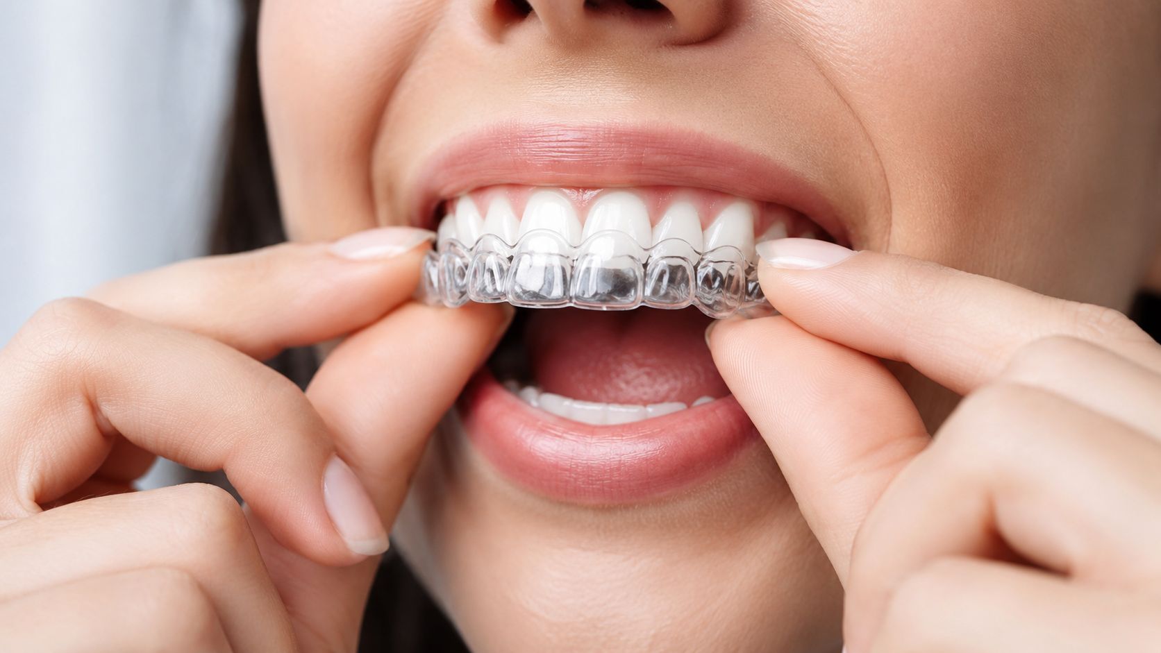 A close-up view of a woman adjusting a clear dental aligner on her upper teeth.