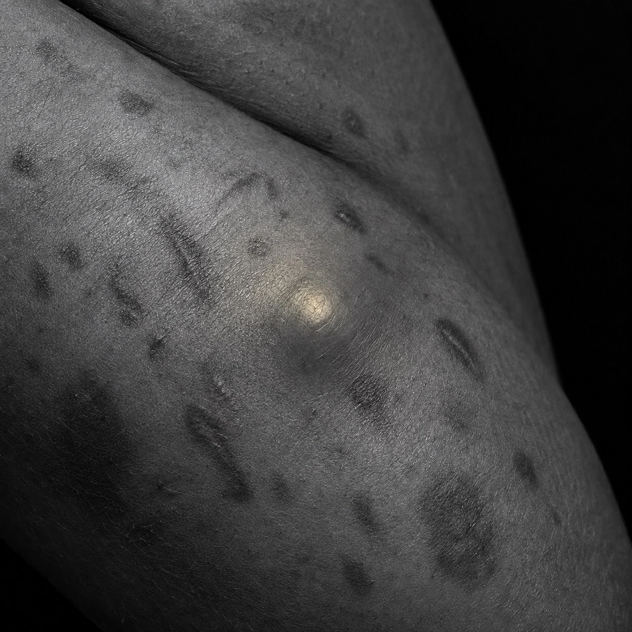 Close-up of skin in a body fold showing the raised nodules and darkened marks typical of hidradenitis suppurativa
