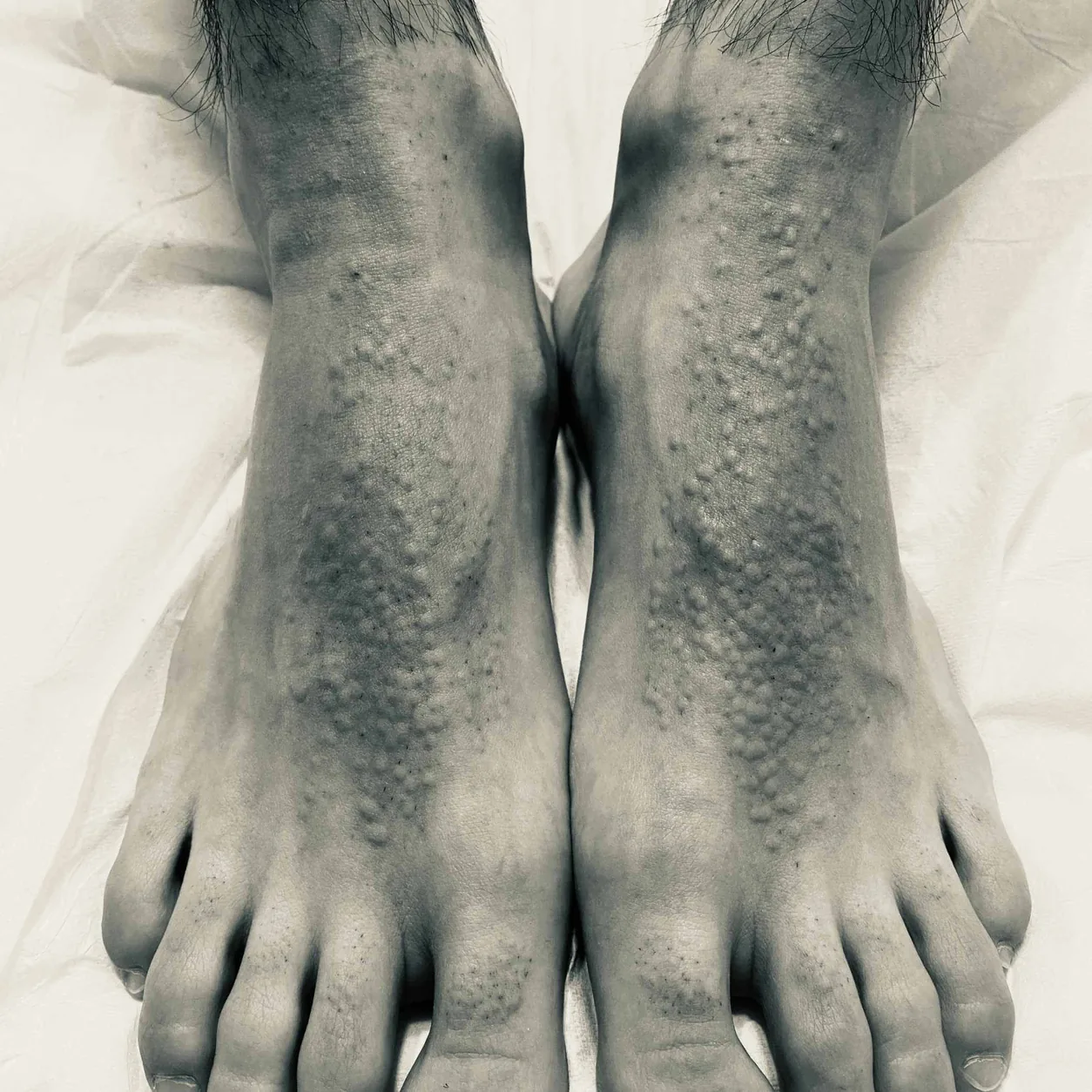 Black and White photo of a pair of feet after laser treatment demonstrating Follicular Edema