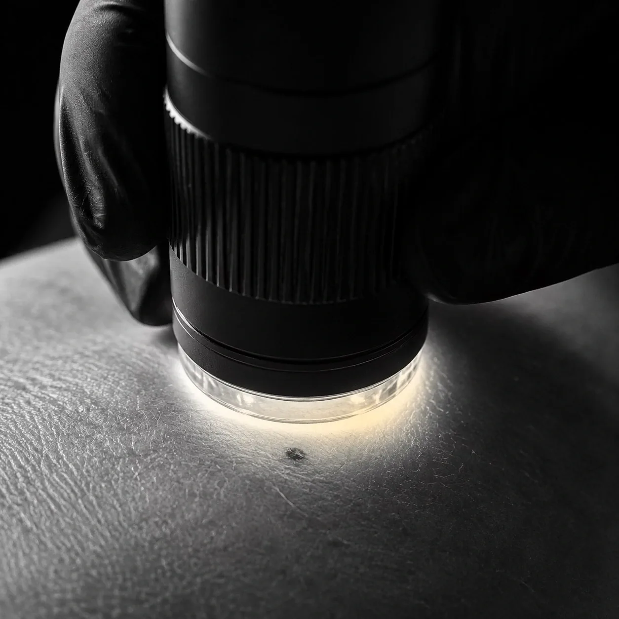 A lit dermatoscope pressed against skin to magnify a small dark mole during a pre-treatment check