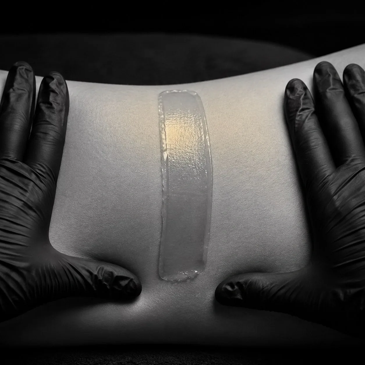 Two gloved hands holding skin taut around a clear numbing cream patch applied before treatment