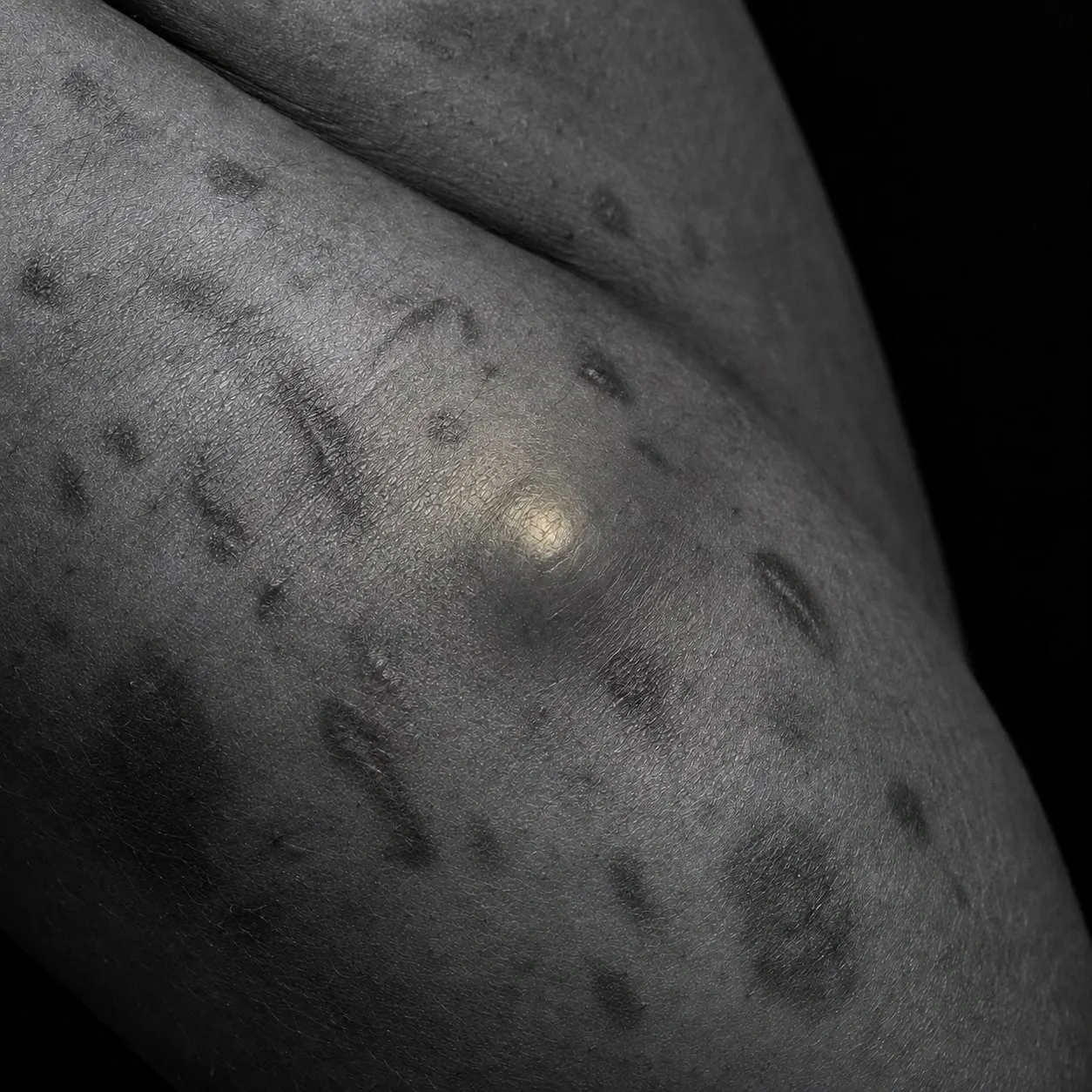 Close-up of skin in a body fold showing the raised nodules and darkened marks typical of hidradenitis suppurativa