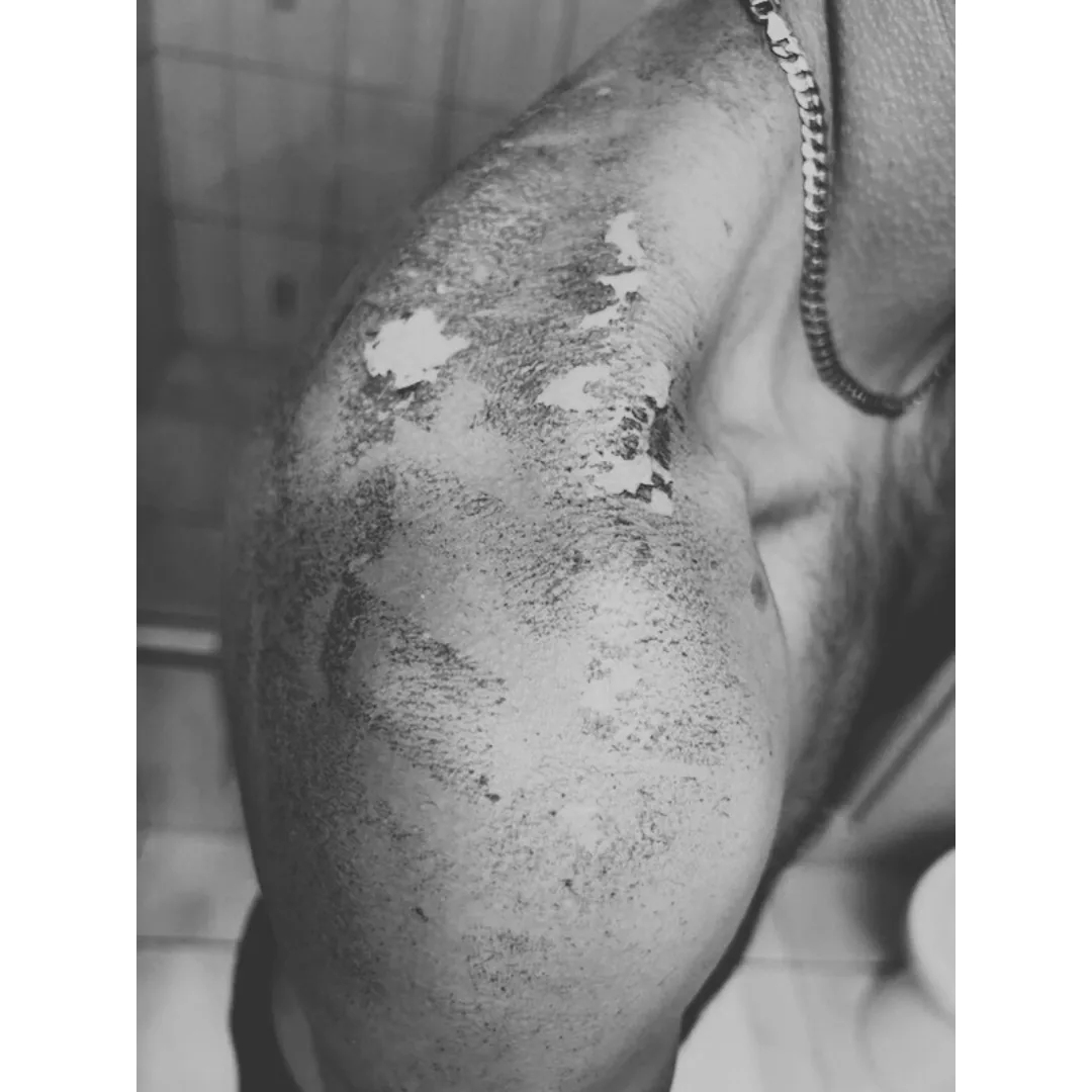 sunburned male back with patches of burns
