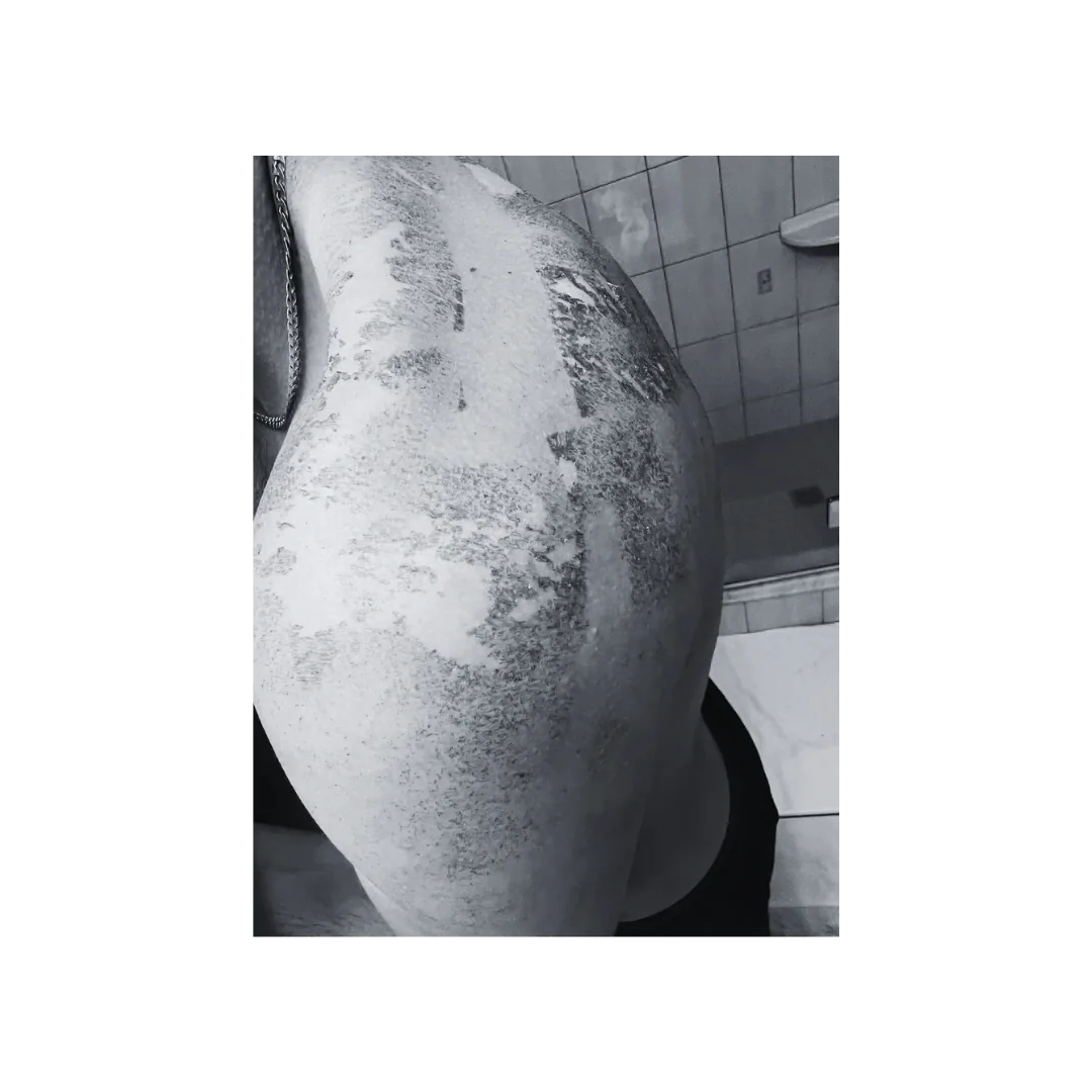 Photograph of a hip and buttock showing severe blistering and peeling after sun-exposed skin was lasered