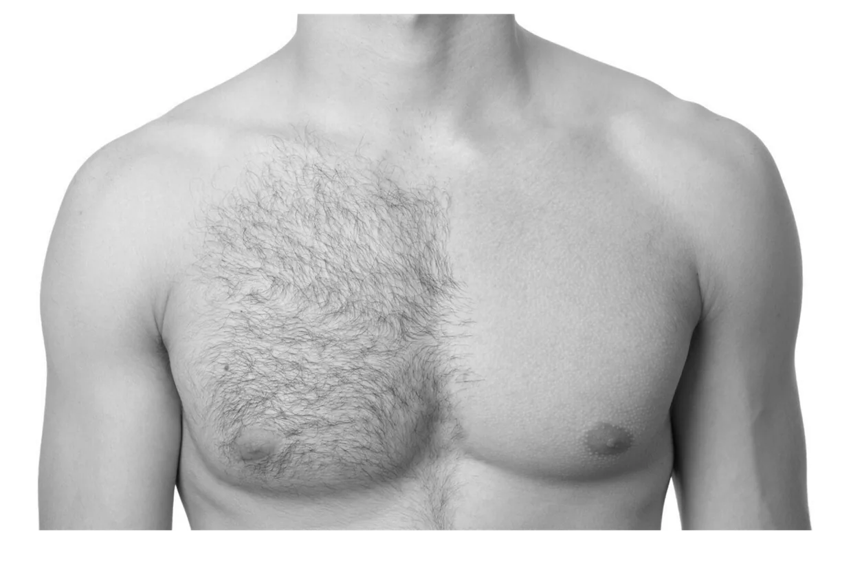 A man's bare chest shown with natural hair on one side and cleanly hair-removed skin on the other