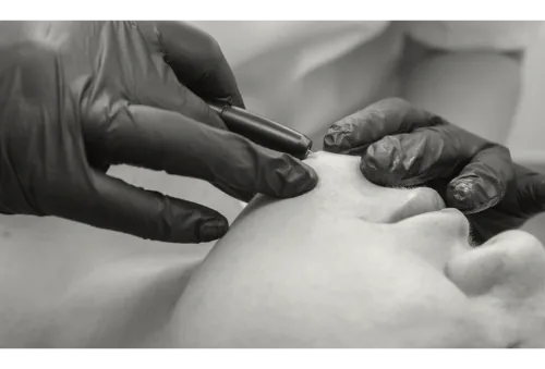 Electrolysis being performed on a face