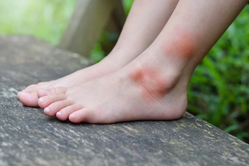 Feet with bug bites.