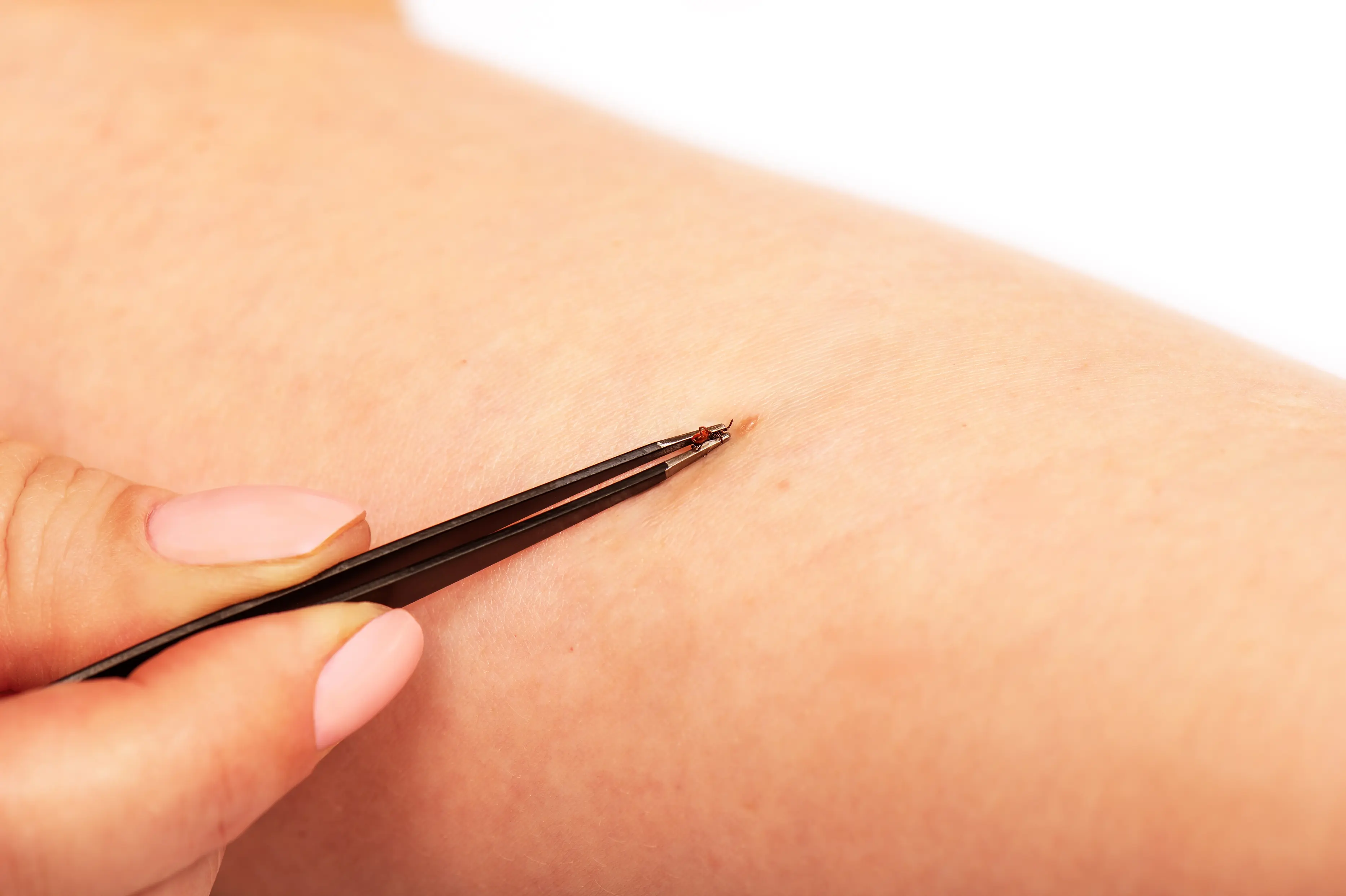 Close-up of a hand using tweezers to remove a tick from skin.