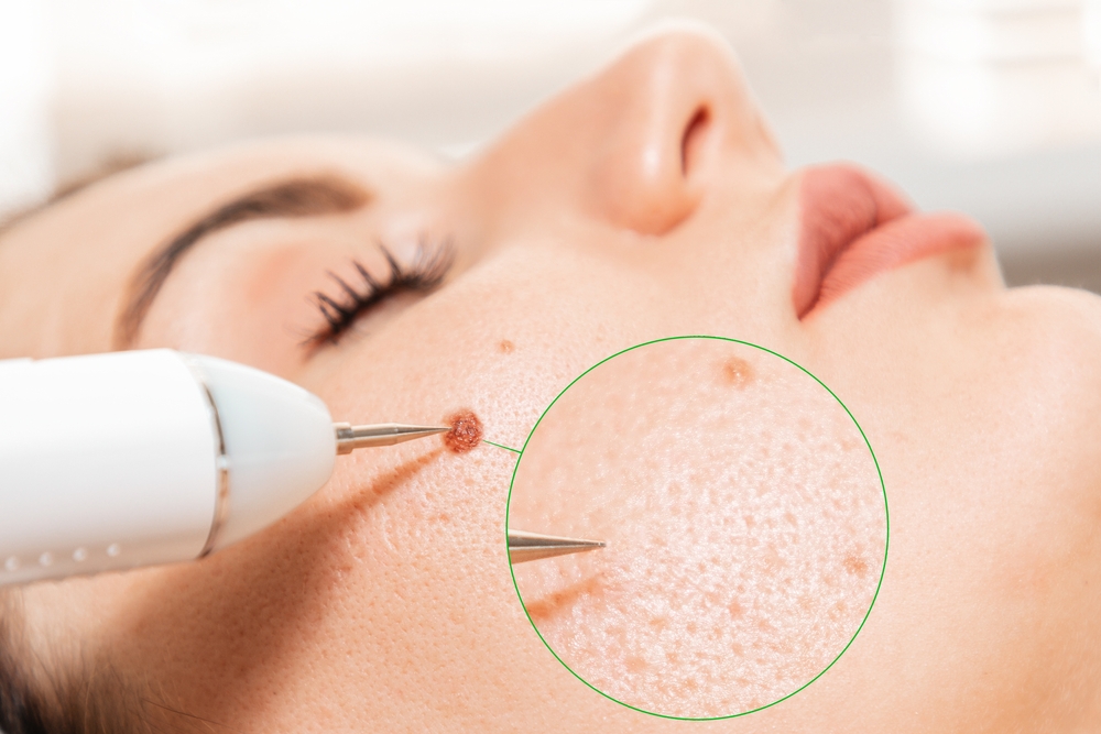 Can My Birthmark be Removed with Laser Treatment?