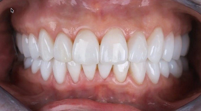 What Is a Trial Smile in Tanglewood? See Your Veneers Before You Commit