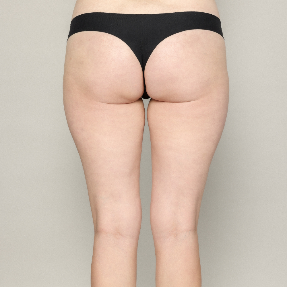 Hip Dips before and after using dermal fillers