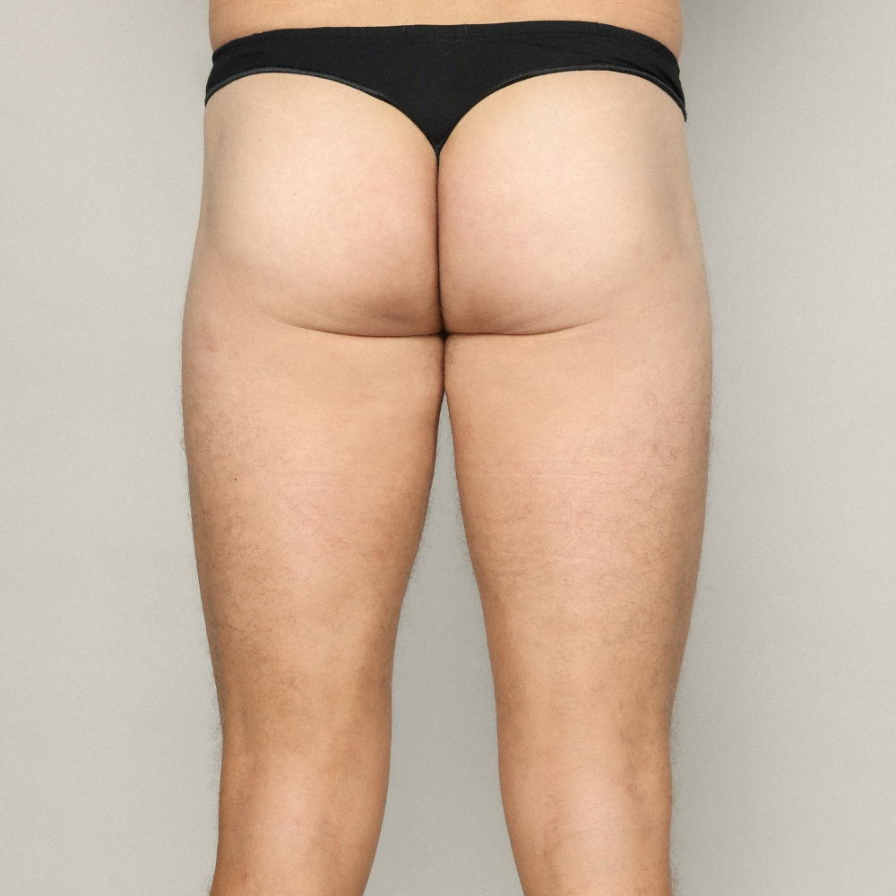 Buttock Before and After - HYAcorp