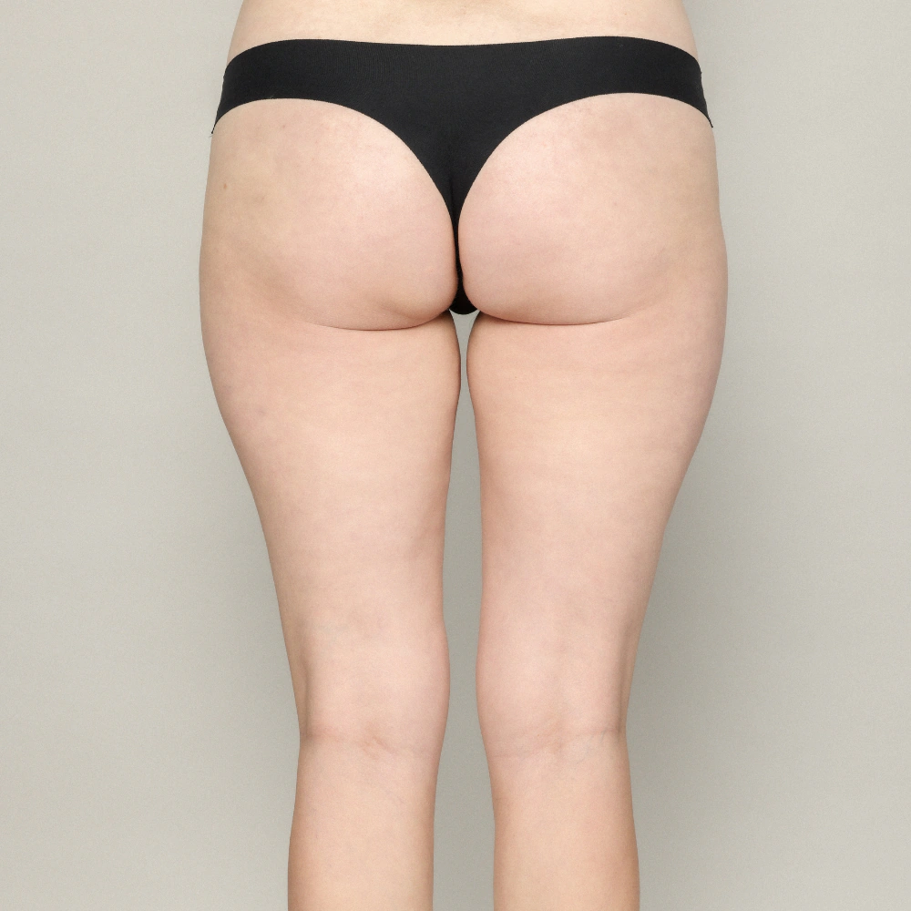 Hip Dips antes y después de usar rellenos dérmicos