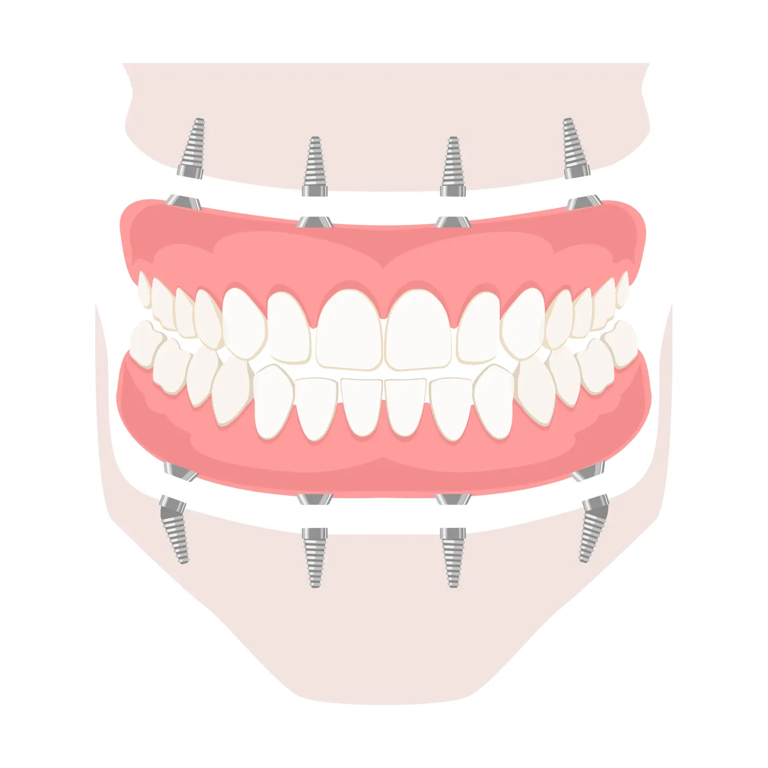 The Life-Changing Benefits of Full-Arch Dental Implants