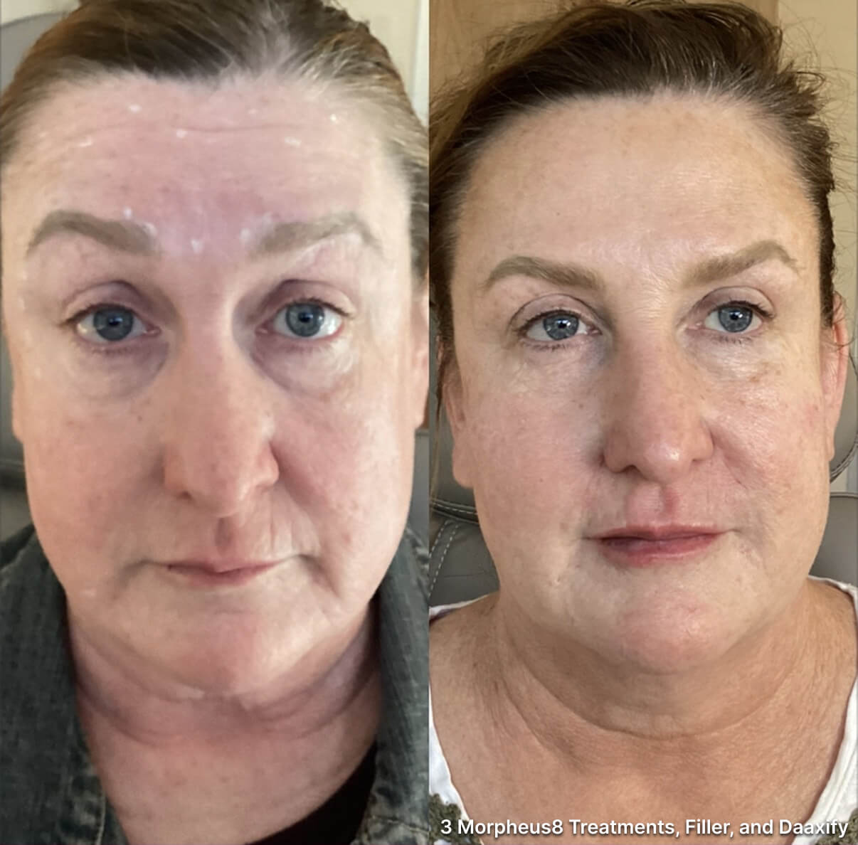 Before and after photos showing facial skin improvement from Morpheus8 treatments and fillers.