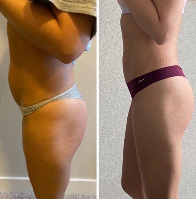 Before and after side profile comparison of a woman's weight loss transformation, showing reduced body fat.