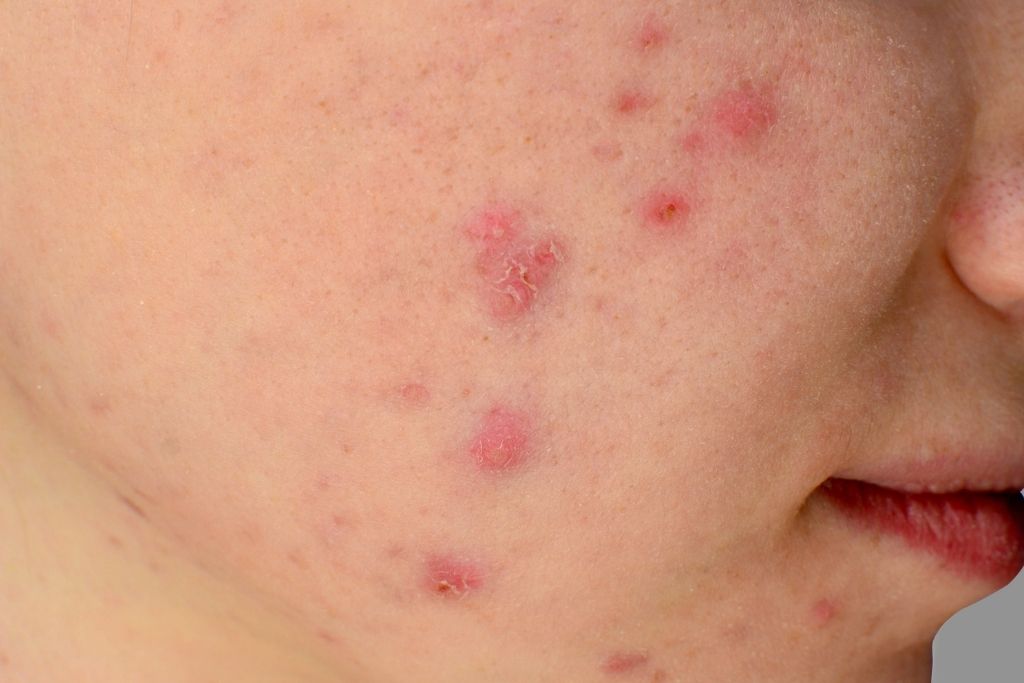 rejuran-s-for-hypertrophic-scars