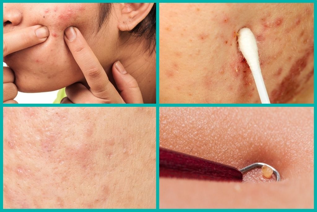 rejuran-s-for-marks-left-by-acne