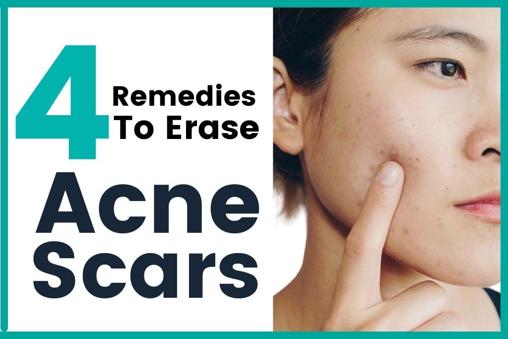 Erase Acne Scars with Rejuran S (And Three Other Remedies You Can Also Try) 