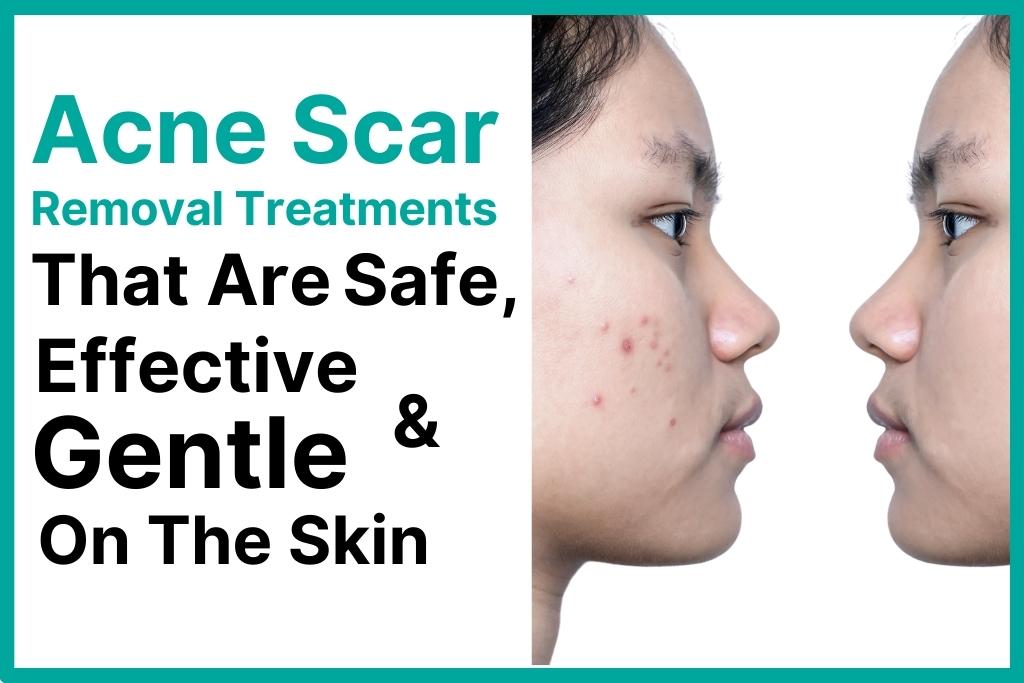 Rejuran S: A Solution for Stubborn Acne Scars