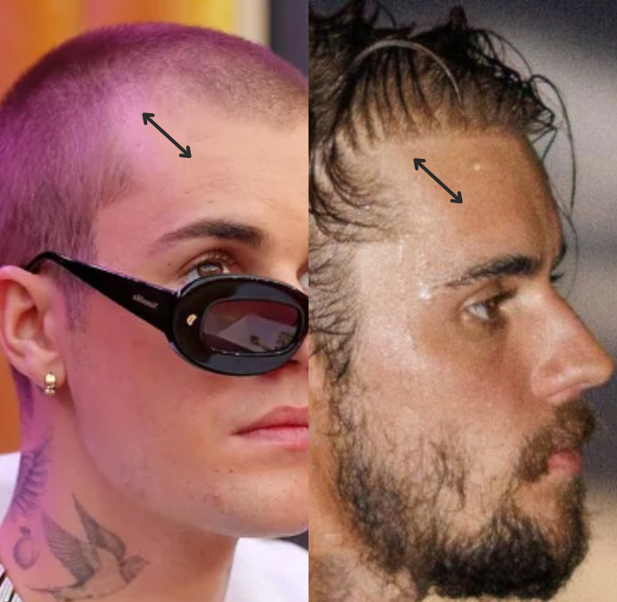 Avant Après Justin Bieber 