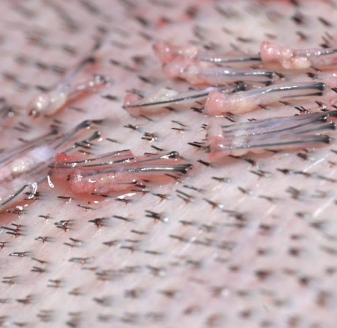 Greffons prélevés pendant greffe de cheveux