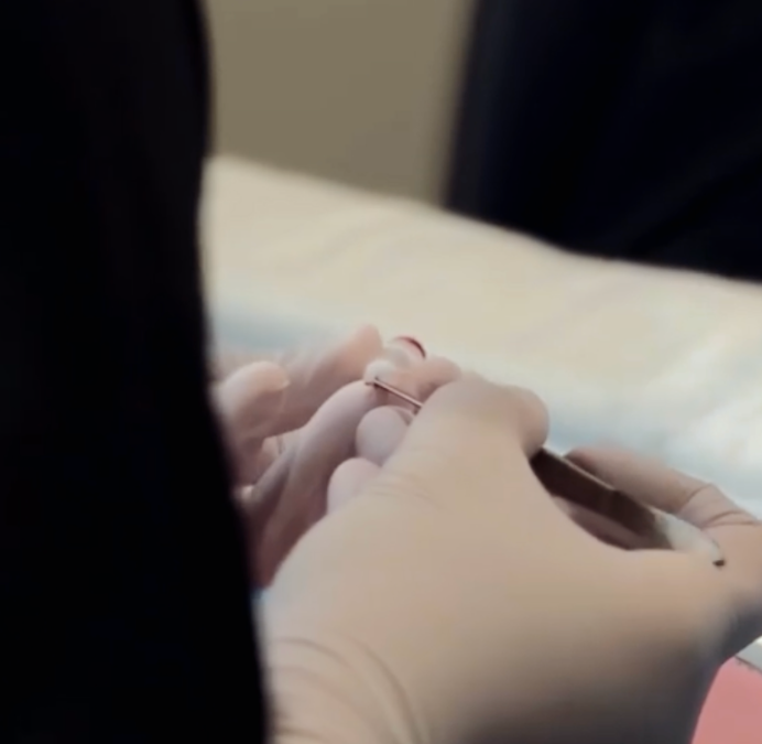 Utilisation implanteur de choï 