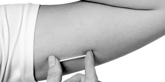 Benefits of Nexplanon IUD Contraception