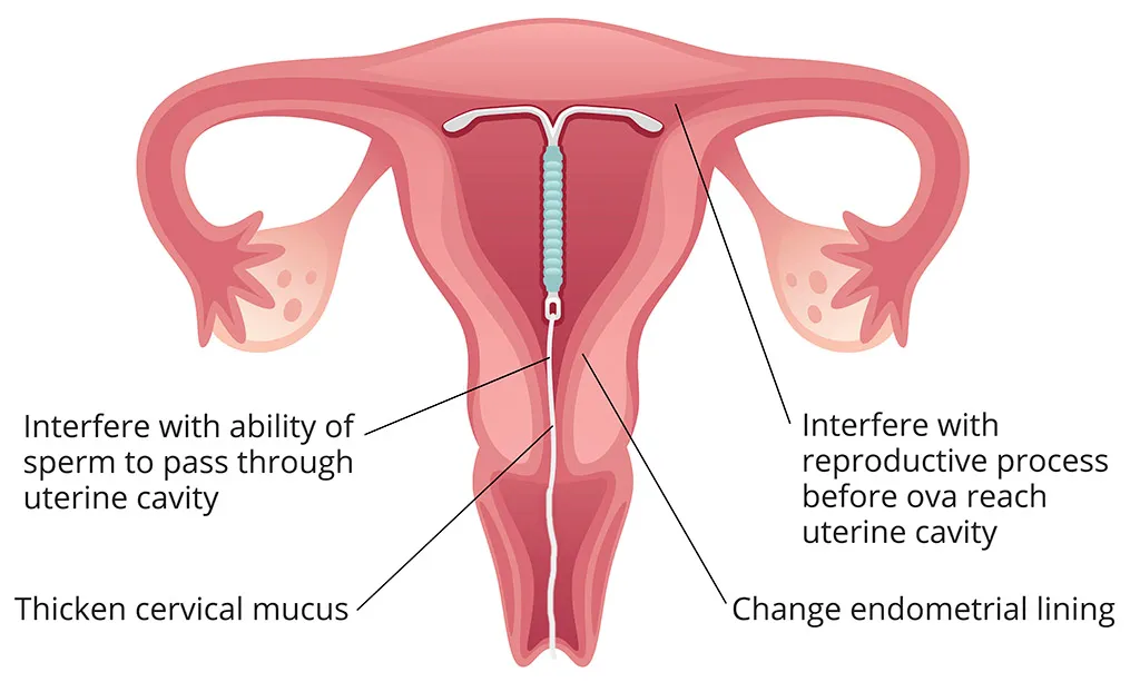 Hormonal progesterone-based IUD