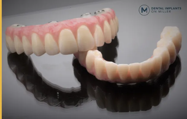 All-on-4 tooth bridge